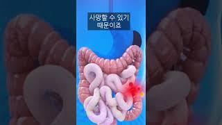 칼에 찔렸을때 살아남는 방법 (칼뽑기vs그대로두기)