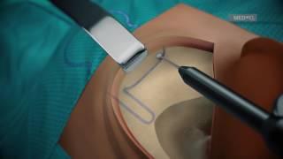 SYNCHRONY PIN Cochlear Implant Surgical Guidelines