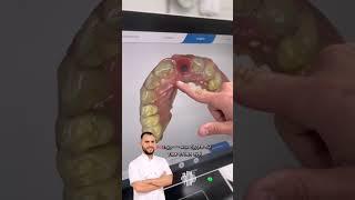 Правильное позиционирование имплантата при протезировании зубов #виниры #shortsvideo #стоматология