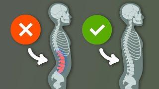 Lordosis? Do THIS for a straighter posture (Hyperlordosis) 