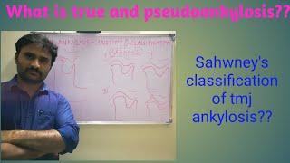 TMJ Ankylosis - anatomy and classification