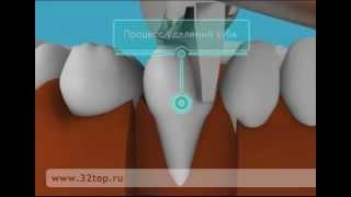 Альвеолит лунки. Альвеолит лечение