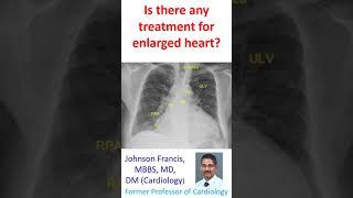 Is there any treatment for enlarged heart?