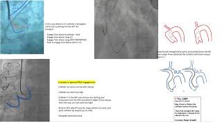 Left+right coronary engagement for general fellows: step-by-step tips, diagrams, caveats (5 for RCA)