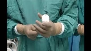 Management of periprosthetic hip joint infection and antibiotic spacer preparation