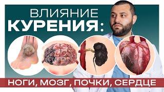 ВЛИЯНИЕ КУРЕНИЯ: НОГИ, МОЗГ, ПОЧКИ, СЕРДЦЕ