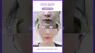 #shorts  강남12 실리프팅 블루로즈 12줄 이중턱 투턱 팔자주름 필러 눈가주름 심부볼 볼살처짐