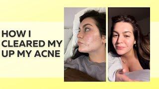 HOW I CLEARED MY ACNE AND KEEP IT AWAY - SKINCARE WORTH YOUR MONEY