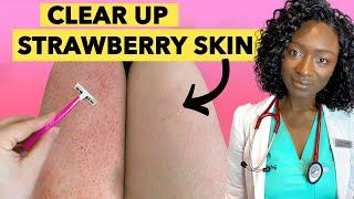  Strawberry Legs - Why it Happens & How to Get Rid Of It + Products