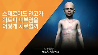 스테로이드 연고가 아토피 피부염을 어떻게 치료할까 - (2014.6.11_505회 방송)_당신의 아이가 위험하다 - 소아 아토피