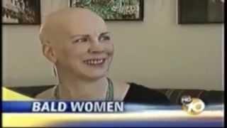 No hair, no problem - life goes on!