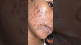 My acne treatment journey #acnetreatment #shorts #skincare #pimple #viral