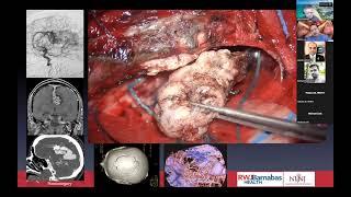 EWNC   Neurosurgical TV   The Most Challenging Cases