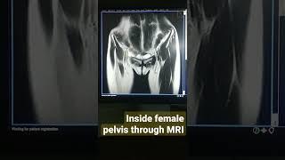 INSIDE FEMALE PELVIS THROUGH MRI SCAN