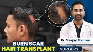 Burn Scar Hair Transplant Success: A Detailed Case Study by Dr. Sanjay Sharma #hairtransplant