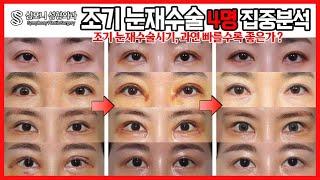 백문이 불여일견, 조기 눈재수술 4명 집중분석 ! (실패한 눈 3주 - 4개월 사례) #조기눈재수술 #눈재수술잘하는곳