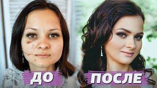 До и после • Как скрыть шрамы и синяки • Ужасная история