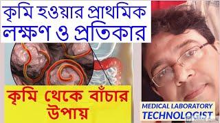 কৃমি হওয়ার প্রথমিক লক্ষণ ও প্রতিকার  Common sign of Intestinal worms and remedies.