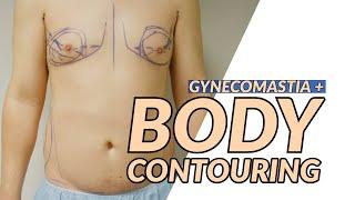 Body Contouring Gynecomastia Surgery with Dr.Dadvand