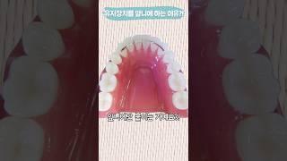 유지 장치는 왜 앞니에만 붙이죠? #shorts