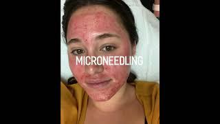 MicroNeedling - Collagen Induction Therapy