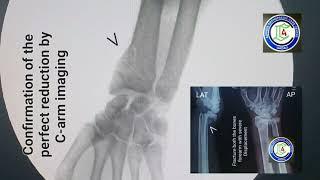 Communited fracture Lower end Radius | Wrist / forearm injuries | Closed reduction | K-wire | Adamya