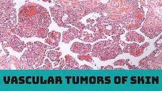 Vascular Tumors of Skin (31 cases in 3 hours): Board Review for Pathology Dermatology Dermpath