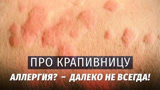 Про крапивницу. Теория и лайфхаки. Аллергия? - Далеко не всегда!!