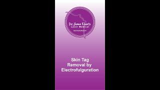 Skin Tag removal by Electrofulguration