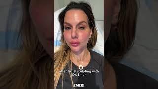 SNATCHED FEMALE FACIAL SCULPTNG | Dr. Jason Emer