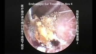 Cleaning of two cases of localized external auditory canal cholesteatoma