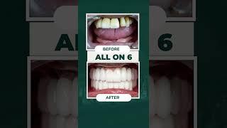 All On 6: The Perfect Lifetime Solution for Missing Teeth!