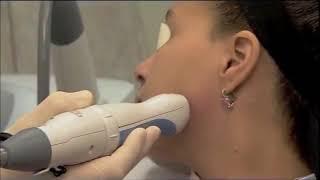 Scar Treatment with Palomar Fractional Laser