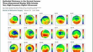 Imaging of the whole crystalline lens by Insight 100 VHF digital ultrasound