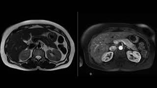 Renal Oncocytoma