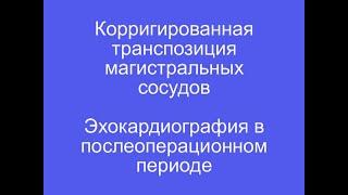 Корригированная транспозиция магистральных артерий, эхокардиография в послеоперационном периоде