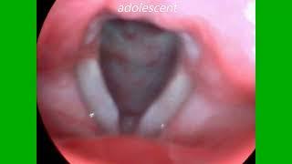 Vocal Fold Nodules In A Child, Adolescent and Adult