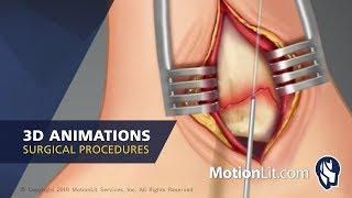 MotionLit Animation & Medical Illustration Samples