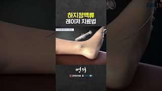 Varicose veins that can get worse in summer