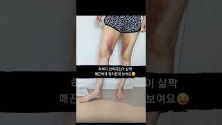 허벅지 지방추출주사 4일~ 6일차 |멍 붓기| #허벅지안쪽살 #diet #지방흡입주사