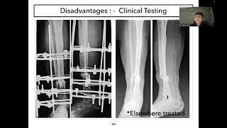 Ilizarov in Fractures - Dr Amar Soni