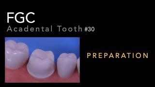 Full Gold Crown Preparation - #30 Acadental Tooth