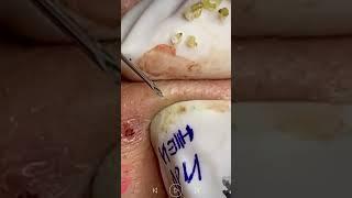 Skincare | Blackheads Removal #487 #tweezers skincare #blackheads blackheads