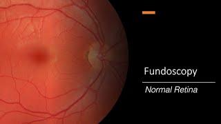 Healthy Retina: Fundoscopy