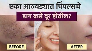 एका आठवड्यात पिंपल्सचे डाग कसे दूर होतील? | How To Get Rid Of Pimples | Home Remedies For Pimples