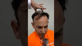 Transplante de cabello - paso a paso | Care4Hair