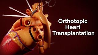 Medical Animation: Orthotopic Heart Transplantation | Cincinnati Children's