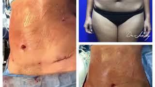 Liposuction before and after  | Before and after lipo