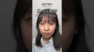 鼻フルしたらどれくらい変わる#アストラビューティークリニック #astrabeautyclinic #塩満先生 #塩満恵子 #忘れ鼻 #鼻整形 #鼻整形ダウンタイム #垢抜け #美容外科 渋谷