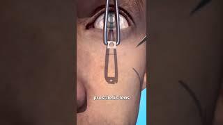 Tooth In Eye Surgery  (explained)